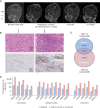 Figure 6. Delayed response after initial progression on continued anti–PD-1 monotherapy. A, Delayed response after initial progression on nivolumab monotherapy. B, Cyst decompression and biopsy at progression showed a more mitotically active and higher grade tumor with higher TMB and increased CD8 T-cell infiltration. C, Mutation overlap showed minimal overlap of the somatic mutational spectrum between the two time points (200X magnification; scale bars represent 50 µm). D, Normalized expression counts of immune markers before initiation and after progression on anti–PD-1 monotherapy using the NanoString platform (100X magnification, scale bars represent 100 µm; Methods).