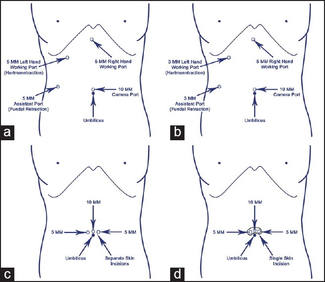 Techniques of laparoscopic cholecystectomy: Nomenclature and selection ...