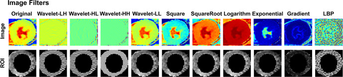 Examples of radiomic features extracted from cardiac MR images (T1 mapping in this example) in a 62-year-old female patient by using PyRadiomics. (a) Cardiac MR image and the manually delineated ROI were given as inputs, and image filters were applied on the original image to create additional radiomic features. (b) A total of 1023 features were extracted from various feature families. GLCM = gray-level co-occurrence matrix, GLDM = gray-level dependence matrix, GLRLM = gray-level run length matrix, GLSZM = gray-level size-zone matrix, LBP = local binary pattern, NGTDM = neighboring gray-tone-difference matrix, ROI = region of interest, wavelet-HH = wavelet high-pass filter applied in horizontal and vertical directions, wavelet-HL = wavelet high- and low-pass filters applied in horizontal and vertical directions, wavelet-LH = wavelet low- and high-pass filters applied in horizontal and vertical directions, wavelet-LL = wavelet low-pass filter applied in horizontal and vertical directions.