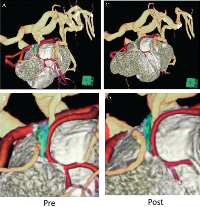 Trigeminal Neuralgia Caused by a Persistent Primitive Trigeminal Artery ...