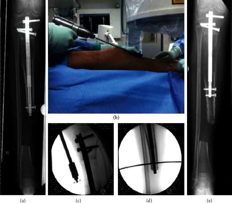 Fibula-Assisted Segment Transport (FAST) for Defect Reconstruction ...