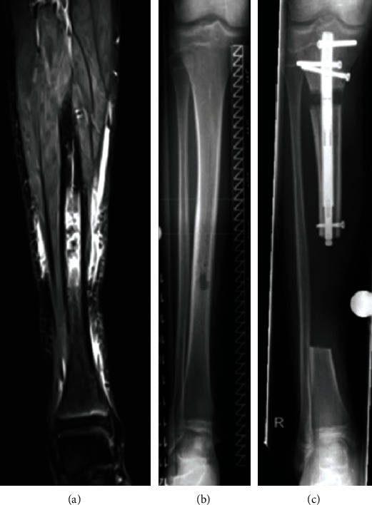 Fibula-Assisted Segment Transport (FAST) for Defect Reconstruction ...