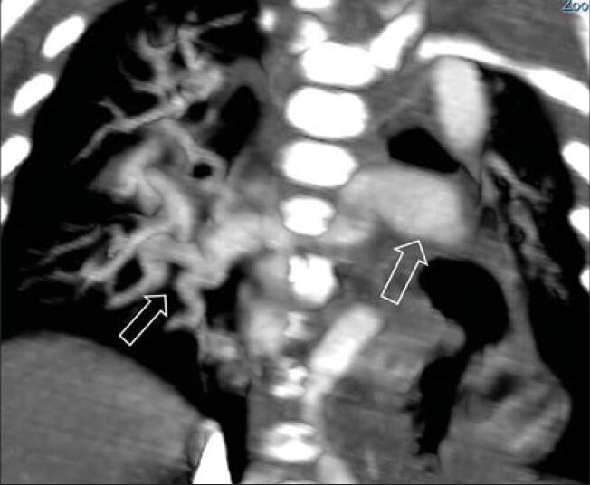 Arterial Tortuosity Syndrome: An Approach through Imaging Perspective - PMC