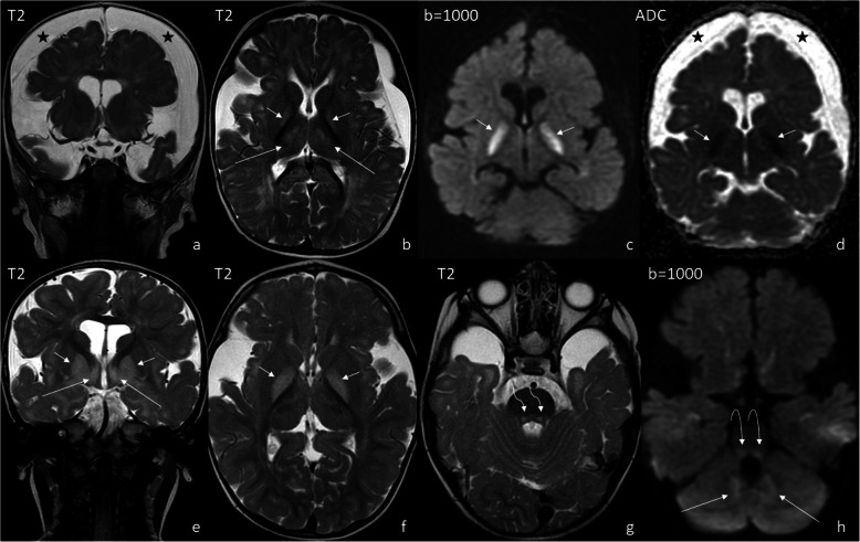 Increasing the spectrum of white matter diseases with tigroid pattern ...