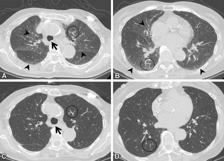 Suboptimal inspiration in an 87-year-old woman who underwent CT for evaluation of a lung nodule. (A, B) Axial CT images show ground-glass abnormalities (arrowheads) in subpleural and central areas of the lung zone. Anterior bulging of the posterior membranous portion of the trachea (arrow in A) and tortuosity of the vessels (circle) suggest suboptimal inspiration. (C, D) Follow-up axial CT images show that the ground-glass abnormality has disappeared, and the normal round shape of the trachea is seen (arrow in C). Tortuosity of the vessels (circle) is no longer seen, and the lung volume, as compared with that in A and B, has improved.