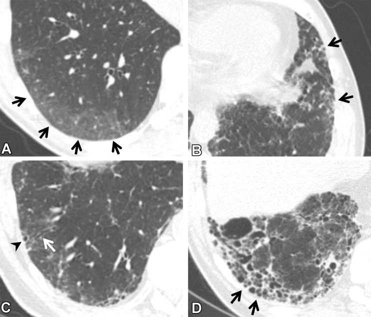 CT findings that constitute ILAs. Axial images show ground-glass abnormality (arrows in A), reticulation (arrows in B), traction bronchiectasis (arrow in C), nonemphysematous cyst (arrowhead in C), and honeycombing (arrows in D).