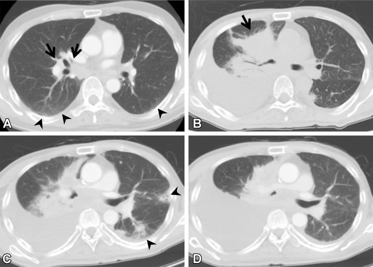 ICI-related pneumonitis in a 62-year-old man with squamous cell cancer. The patient was treated with nivolumab as the sixth line of therapy. (A) Axial pretreatment CT image shows subtle ground-glass abnormality (arrowheads) in the subpleural area, indicating ILA. Right hilar lymphadenopathy (arrows) also is apparent. (B) Axial CT image 10 months later shows a mass (arrow) in the right lung and pleural effusion, suggesting tumor exacerbation. (C) Axial CT image 20 days after the patient started nivolumab therapy shows a newly emergent patchy ground-glass abnormality and consolidation (arrowheads), representing ICI-related pneumonitis with an organizing pneumonia pattern; nivolumab was discontinued. (D) Axial CT image 3 months after the discontinuation of nivolumab shows that the patchy opacities have disappeared.