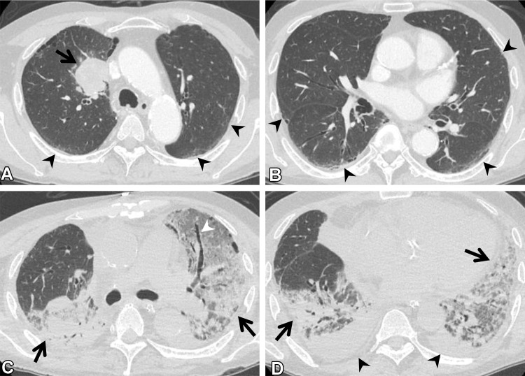 Postoperative complications in a 66-year-old man with squamous cell cancer. (A, B) Axial preoperative CT images show a mass (arrow in A) in the right upper lobe of the lung. Subtle ground-glass abnormality (arrowheads), indicating ILA, is seen in the subpleural area. (C, D) Axial postoperative CT images show diffuse ground-glass abnormality and consolidation (arrows) with traction bronchiectasis (arrowhead in C). Pleural effusion (arrowheads in D) also is seen. The patient was clinically diagnosed to have pneumonia and acute respiratory distress syndrome.