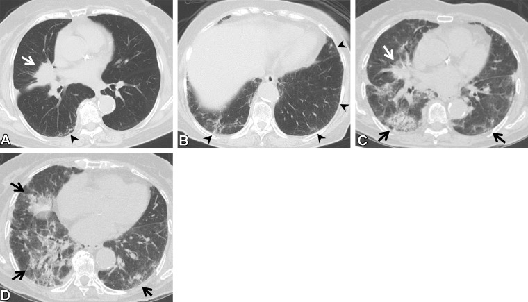 Complications of targeted drug therapy in an 85-year-old woman with adenocarcinoma who was treated with osimertinib. (A, B) Axial pretreatment CT images show a mass (arrow in A) in the right middle lobe. The ground-glass abnormality and reticulation (arrowheads) seen in the subpleural area suggest ILA. The patient’s Krebs von den Lungen 6 and surfactant protein D levels were normal. (C, D) Axial CT images at 5 months of treatment show the mass (white arrow in C), and diffuse ground-glass abnormality and consolidation (black arrows), which indicate pneumonitis. The patient was short of breath and was treated with steroids.