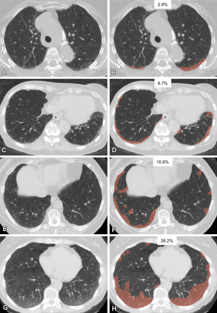 Various extents of lung abnormality in four patients. Original axial CT images (A, C, E, G) and the same CT images with a segmented overlay of ILA (B, D, F, and H) are shown. (A, B) Scans in a 76-year-old woman show subtle subpleural ground-glass abnormality that accounts for 2.9% of the lung area, indicating insignificant abnormality. (C, D) Scans in an 84-year-old woman show ground-glass and reticular abnormalities that account for 6.7% of the lung area, indicating significant abnormality. (E, F) Scans in a 73-year-old woman show faint ground-glass abnormality that accounts for 10.6% of the lung area, indicating significant abnormality. (G, H) Scans in a 60-year-old woman show widespread ground-glass abnormality that affects 26.2% of the lung area, indicating significant abnormality. The segmentations shown were performed manually by using 3D Slicer software (Brigham and Women’s Hospital, Harvard Medical School, Boston, MA).