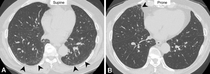 Dependent abnormality in a 72-year-old man with rheumatoid arthritis. (A) Axial CT image obtained with the patient supine shows ground-glass abnormality (arrowheads) in the subpleural lung area. (B) On the axial CT image obtained with the patient prone, the ground-glass abnormality has disappeared in the subpleural area but is seen in the middle lobe of the right lung (arrowhead). These findings are considered to indicate transient lung atelectasis.