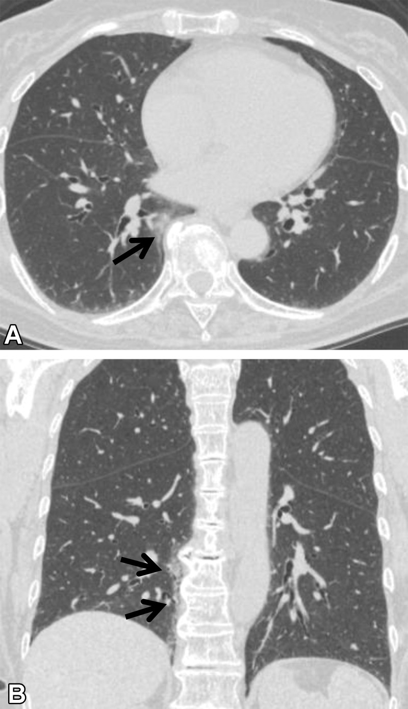 Osteophyte-related lesion in a 72-year-old woman with no respiratory symptoms. (A) Axial CT image shows ground-glass abnormality adjacent to an osteophyte (arrow). (B) Coronal CT image shows the craniocaudal alignment (arrows) of the abnormality.