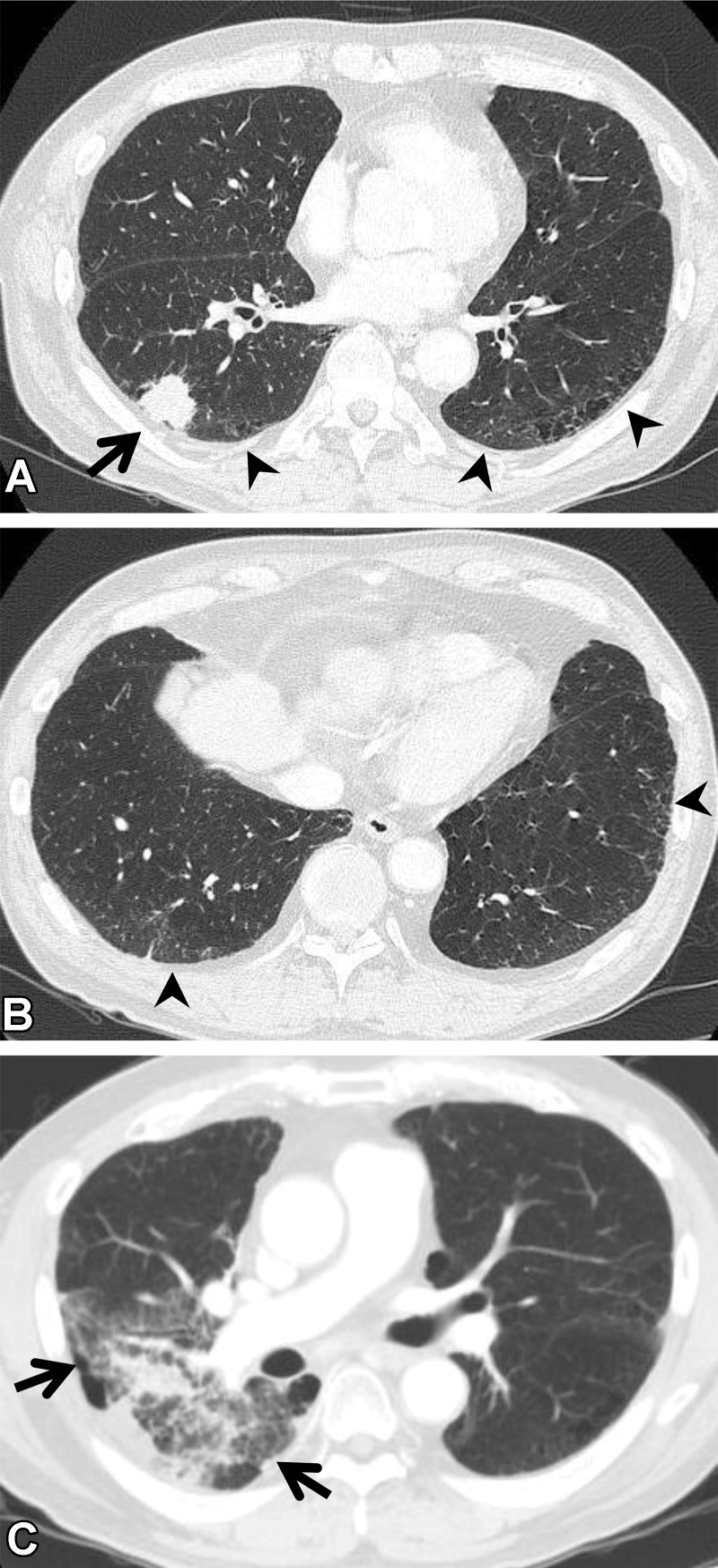 RP in a 64-year-old man with squamous cell cancer. (A, B) Axial pretreatment CT images show a nodule (arrow in A) in the right upper lobe and ground-glass abnormality (arrowheads) in the subpleural area, suggesting ILA. (C) Axial CT image after radiation therapy shows ground-glass abnormality and consolidation (arrows) in the right lung, beyond the irradiated field. The patient required steroid therapy for RP.