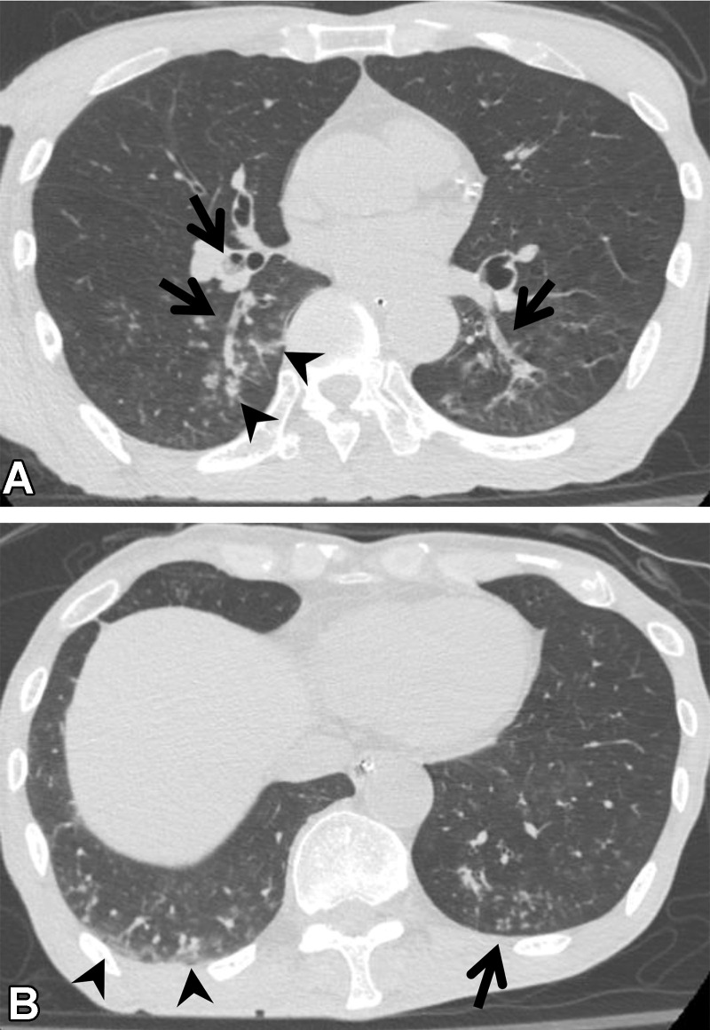 Aspiration in a 64-year-old man with corticobasal degeneration. (A) Axial CT image shows central airway plugging (arrows) and centrilobular nodularity (arrowheads) bilaterally in the lower lung lobes. (B) Axial CT image at the level of the lung base shows ground-glass abnormality (arrowheads) in the subpleural area and peripheral centrilobular nodules (arrow).