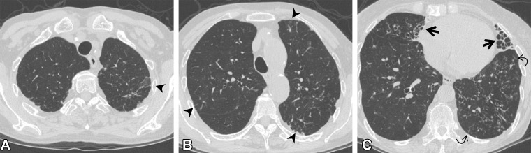 Mycobacterium intracellulare infection (non-ILA) in a 72-year-old woman. (A, B) Axial CT images show linear opacity and ground-glass abnormality (arrowheads) in the subpleural area of the upper lung lobes. (C) Axial CT image at a lower level shows bronchiectasis and reticulation (straight arrows) in the middle lobe and lingula and centrilobular nodularity (curved arrows) in the left lower lobe. These findings are typical of nontuberculous mycobacterial pulmonary disease, suggesting that the abnormalities at the upper level are related to infection or postinfection change. The findings in this patient were not considered to indicate ILA.