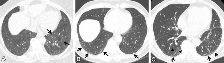 Subcategories of ILA seen on axial CT images. (A) Nonsubpleural ILA: faint ground-glass abnormality (arrows) in the central and subpleural areas of the lungs but not predominant in the subpleural area. (B) Subpleural nonfibrotic ILA: ground-glass abnormality (arrows) without fibrosis such as bronchiectasis and architectural distortion. (C) Subpleural fibrotic ILA: ground-glass abnormality and linear opacities (arrows), with traction bronchiectasis (arrowheads).