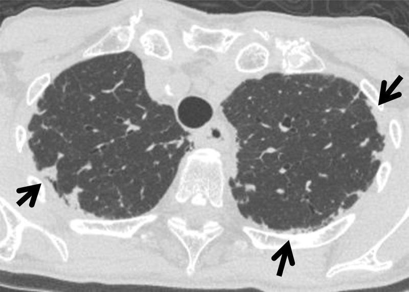 PPFE-like lesion in a 73-year-old woman. Axial CT image shows subpleural soft-tissue attenuation with irregular borders (arrows) in the upper lungs. There was no interval change in this abnormality at follow-up.