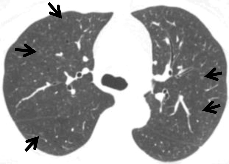 Centrilobular nodularity in a 50-year-old woman who currently smoked and had a history of 35 pack-years without respiratory symptoms. Axial CT image shows small nodules (arrows) with centrilobular distribution in the bilateral lungs.