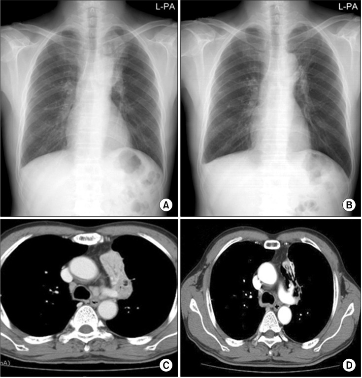 Successful Removal of Endobronchial Lipoma by Flexible Bronchoscopy ...