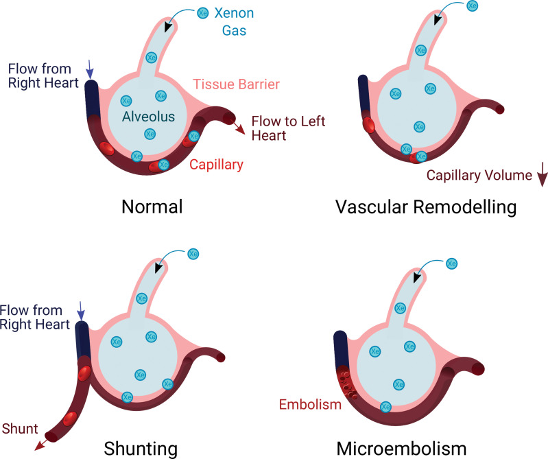 Illustrations show proposed mechanisms explaining relationships for xenon 129 (129Xe) MRI red blood cell (RBC) area under the receiver operating characteristic curve. (A) Gas exchange in a healthy individual occurs as xenon diffuses through the tissue barrier and attaches to RBCs. (B) Vasoconstrictive remodeling following infection reduces the available blood volume for 129Xe binding. (C) Changes to vascular resistance and flow patterns may result in redistributions of pulmonary blood through shunting away from 129Xe ventilated regions. (D) Thrombus or microembolism blocks capillary-level blood flow, preventing 129Xe uptake in RBC and redistributing blood upstream in the vasculature.