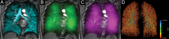 Xenon 129 (129Xe) gas-transfer MRI and CT scans of pulmonary vessels in a 59-year-old never-hospitalized female participant with post-acute COVID-19 syndrome (red blood cell [RBC]:barrier = 0.26 and CT blood volume in vessels with cross-sectional area ≤5 mm2 normalized to total blood volume = 62%). (A) 129Xe ventilation MRI scan. (B) 129Xe barrier MRI scan. (C) 129Xe RBC MRI scan. (D) CT vessel tree. Cyan represents 129Xe MRI ventilation (xenon in the gas compartment), green represents 129Xe barrier signal intensity (xenon in the barrier compartment), and magenta represents 129Xe RBC signal intensity (xenon in the RBC compartment).