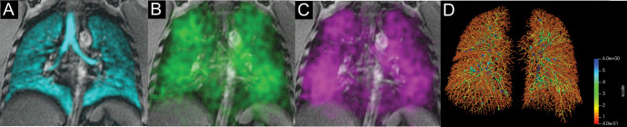 Xenon 129 (129Xe) gas-transfer MRI and CT scans of pulmonary vessels in a 42-year-old male participant who had been previously infected with COVID-19 and admitted to in-patient treatment in hospital with post-acute COVID-19 syndrome (red blood cell [RBC]:barrier = 0.33 and CT blood volume in vessels with cross-sectional area ≤5 mm2 normalized to total blood volume = 54%). (A) 129Xe ventilation MRI scan. (B) 129Xe barrier MRI scan. (C) 129Xe RBC MRI scan. (D) CT vessel tree. Cyan represents 129Xe MRI ventilation (xenon in the gas compartment), green represents 129Xe barrier signal intensity (xenon in the barrier compartment), and magenta represents 129Xe RBC signal intensity (xenon in the RBC compartment).