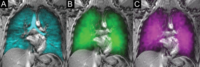 Xenon 129 (129Xe) gas-transfer MRI scans in a 30-year-old male control participant with red blood cell (RBC):barrier ratio = 0.52. (A) 129Xe ventilation MRI scan. (B) 129Xe barrier MRI scan. (C) 129Xe RBC MRI scan. Cyan represents 129Xe MRI ventilation (xenon in the gas compartment), green represents 129Xe barrier signal intensity (xenon in the barrier compartment), and magenta represents 129Xe RBC signal intensity (xenon in the RBC compartment).