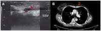Figure 1. Ultrasound imaging and computed tomography of chest wall skin recurrence of breast cancer. Local recurrence of breast carcinoma (arrow) in the area of the mastectomy scar of the chest wall i...