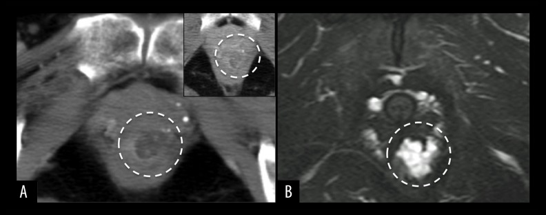 Anal Canal Adenocarcinoma In A Patient With Longstanding Crohn’s ...