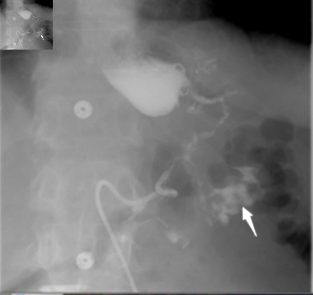 Gastrocolic Fistula: An Extraordinary Gastrointestinal Fistula - PMC