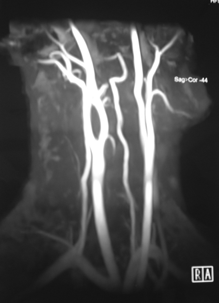 Carotid Body Tumors and Our Surgical Approaches - PMC