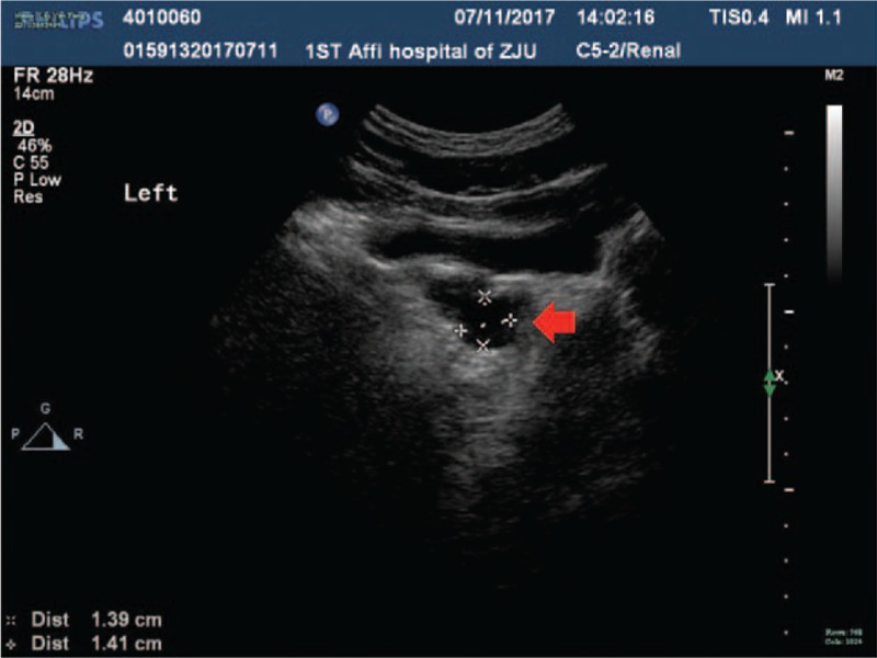 Prostatic cyst in general practice: A case report and literature review ...