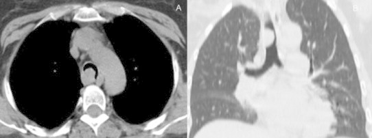 Endotracheal Ectopic Parathyroid Adenoma Mimicking Asthma - Pmc