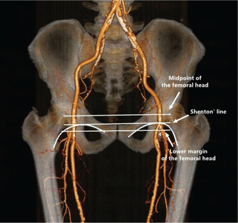 Clinical application of Shenton's line to determine the femoral artery ...