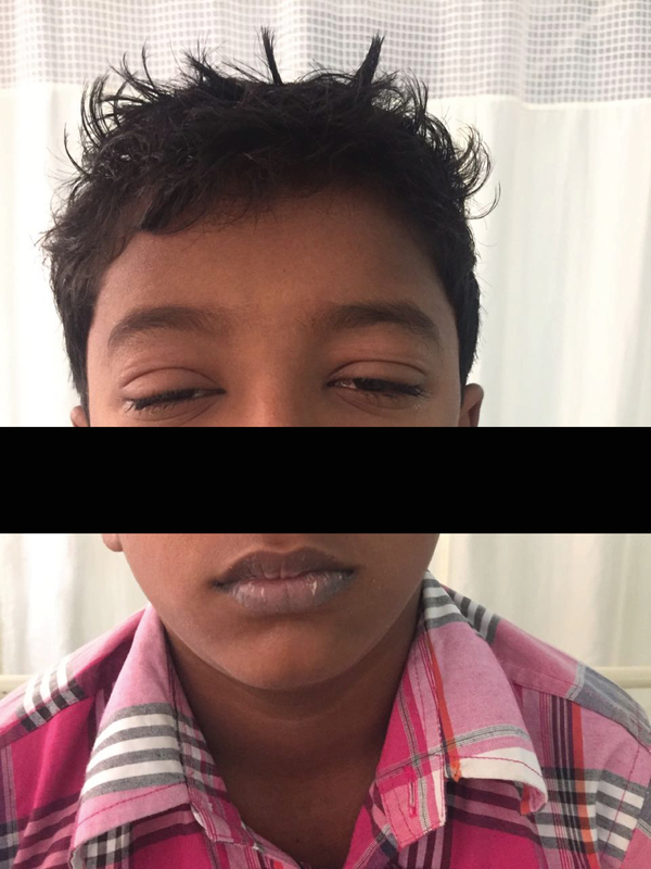 DRESS Syndrome Secondary to Carbamazepine Therapy Presenting with