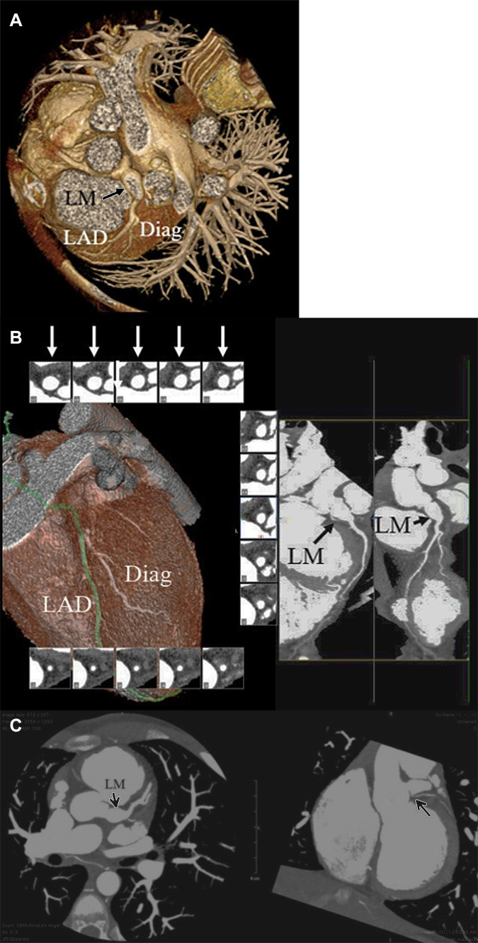 Coronary CT angiographic images in a 14-year-old boy with chronic phase Kawasaki disease CAA who has undergone thrombectomy and aneurysm reduction surgery. A residual fusiform aneurysm of the LM coronary artery, measuring up to 9 mm in diameter over a length of 11 mm was present. (A) Three-dimensional volume-rendered image shows the LM CAA (arrow). (B) Two-dimensional curved multiplanar and reformat views show patency of the LM into the aneurysm (long black arrow), aneurysm lumen (short black arrow), and patency of the LAD and first diagonal branch. Short-axis views of the LM aneurysm show a patent and aneurysm lumen (white arrows). (C) Left: Two-dimensional double oblique view shows patency of the LM into the aneurysm, aneurysm lumen, and LAD artery and first diagonal branch (arrow). Right: Two-dimensional double oblique view shows the LM residual aneurysm. The LCX coronary artery is occluded. A small collateral vessel arises from the proximal LM coronary artery and supplies the LCX territory (arrow). CAA = coronary artery aneurysm, Diag = diagonal, LAD = left anterior descending, LCX = left circumflex artery, LM = left main.