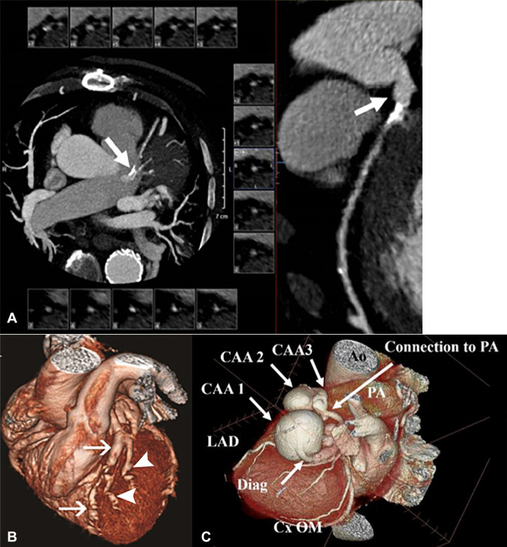 Non–Kawasaki disease CAAs. (A) Coronary CT angiographic (CCTA) images in a 71-year-old man with multivessel coronary artery disease with an atherosclerotic left main CAA. Left: Curved multiplanar reformat shows an aneurysm. Right: Two-dimensional double oblique view. (B) CCTA image in a 29-year-old woman with systemic lupus erythematosus vasculitis with multiple CAAs. Three-dimensional volume-rendered views with inclusion of the background cardiac anatomy show multiple aneurysms in the LAD coronary artery (arrows) and diagonal vessels (arrowheads). (Reprinted, with permission, from reference 56.) (C) CCTA image in a 76-year-old man with multiple potential causes of CAA. A three-dimensional reconstruction of three serial aneurysms of the diagonal artery shows three giant aneurysms that were present in the first diagonal branch of the LAD coronary artery. The largest measured 4 × 4.4 × 3.6 cm, followed by two additional smaller aneurysms. The artery terminated into a small (2.5 mm) fistulous tract to the main PA. The RCA ostium was mildly aneurysmal. A right bronchial artery aneurysm and focal dilated peripheral branches of the pulmonary arteries in the right upper lobe were also present. Multiple causes are possible, including previous vasculitis, given the multiple aneurysms in multiple vascular distributions, atherosclerotic vascular disease, and the presence of a small arterial to venous fistula in the diagonal artery aneurysms. Ao = aorta, CAA = coronary artery aneurysm, Cx = circumflex, Diag = diagonal, LAD = left anterior descending, OM = obtuse marginal, PA = pulmonary artery, RCA = right coronary artery.