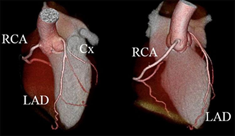 Coronary CT angiographic images in a 21-year-old man with a history of Kawasaki disease in childhood. Three-dimensional reconstructions show no evidence of coronary artery aneurysm. Cx = circumflex, LAD = left anterior descending artery, RCA = right coronary artery.