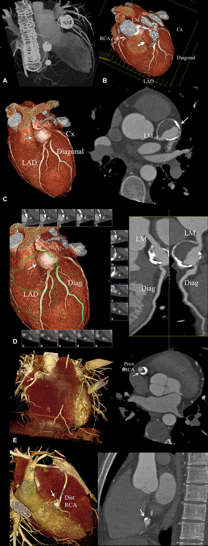 Coronary CT angiographic images in a 25-year-old man with chronic phase Kawasaki disease. CAAs are seen in the distal LM coronary artery extending into the proximal LAD coronary artery, proximal RCA, and distal RCA, for which he was continued to be given low-dose aspirin and anticoagulation indefinitely. Features that may enhance long-term risk of myocardial ischemia in this patient include presence of multiple large aneurysms across multiple coronary artery branches, distal CAA, and layered mural thrombus. (A) Thick maximum intensity projection image shows the heavy calcification of the CAA involving the LM coronary artery extending into the LAD coronary artery, proximal RCA, and distal RCA. (B) Three-dimensional volume-rendered image of the distal LM coronary artery extending into the proximal LAD coronary artery (large arrow) viewed in an editing plane that shows layered mural thrombus with a patent lumen. The smaller proximal RCA aneurysm is also seen (small arrow). (C) Left: Three-dimensional volume-rendered image shows the LM coronary artery and LAD CAA (arrow). Right: Two-dimensional double oblique view shows the tissue characteristics of the aneurysm with a calcified shell, layered mural thrombus, and lumen opacified with iodinated contrast material (arrow). The distal LM connection to the aneurysm is shown to be patent. (D) Left: Three-dimensional volume-rendered image shows the curved multiplanar reformat path through the LM-LAD artery aneurysm (arrow) and out the first diagonal (Diag) branch (green line). Right: Two-dimensional curved multiplanar reformat view shows patency of the LM into the aneurysms, aneurysm lumen, and diagonal branch ostium extending from the aneurysm. (E) Left: Three-dimensional volume-rendered image shows the proximal RCA aneurysm (arrow). Right: Two-dimensional double oblique view shows the tissue characteristics of the aneurysm with a thick calcified shell, layered mural thrombus, and lumen opacified with iodinated contrast material (arrow). (F) Left: Three-dimensional volume-rendered image shows the distal RCA aneurysm (arrow). Right: Two-dimensional double oblique view shows the tissue characteristics of the aneurysm with a thick calcified shell, layered mural thrombus, and lumen opacified with iodinated contrast material (arrow). CAA = coronary artery aneurysm, Cx = circumflex, Diag = diagonal, Dist = distal, LAD = left anterior descending, LM = left main, Prox = proximal, RCA = right coronary artery.