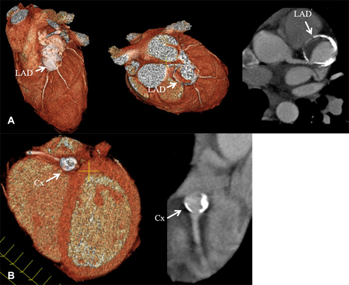 Coronary CT angiographic images in a 15-year-old boy with chronic phase Kawasaki disease CAAs show a heavily calcified, fusiform 1.5 × 0.8-cm aneurysm present within the proximal LAD coronary artery, with prominent mural thrombus. Contrast is seen in the LAD artery distal to the aneurysm. A more saccular-shaped, heavily calcified 1.0 × 0.7-cm aneurysm was present within the proximal LCX artery, without clinically significant mural thrombus. Patient was continued to be given low-dose aspirin and anticoagulation indefinitely. Features found in this patient that may enhance long-term risk of myocardial ischemia include the presence of multiple giant aneurysms across multiple coronary artery branches that contain layered mural thrombus and heavy calcification. (A) Left: Three-dimensional volume-rendered image shows the proximal LAD coronary artery aneurysm (arrow). Middle: Three-dimensional volume-rendered image shows the LAD coronary artery aneurysm (arrow). The editing plane shows the lumen of the LAD artery aneurysm with layered nonocclusive mural thrombus. Right: Two-dimensional double oblique view shows the tissue characteristics of the aneurysm with a calcified shell, layered mural thrombus, and lumen opacified with iodinated contrast material (arrow). The LAD artery connection to the aneurysm is shown to be patent. (B) Left: Three-dimensional volume-rendered image shows the saccular-shaped, heavily calcified aneurysm of the proximal LCX coronary artery (arrow). Right: Two-dimensional double oblique view shows the tissue characteristics of the aneurysm with a calcified shell, minimal mural thrombus, and patent lumen opacified with iodinated contrast material (arrow). CAA = coronary artery aneurysm, Cx = circumflex, LAD = left anterior descending, LCX = left circumflex.