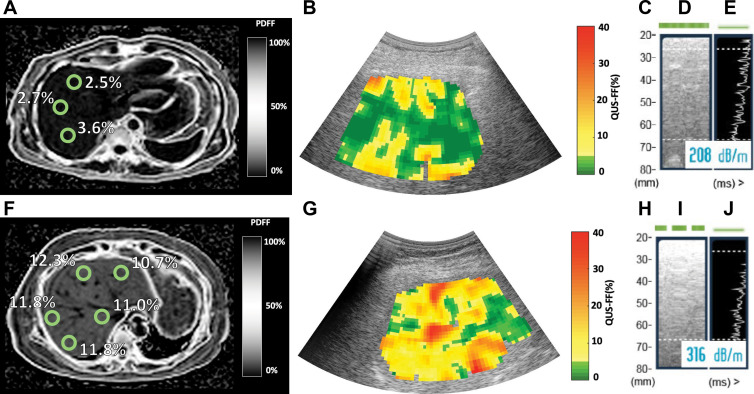 MRI-derived proton density fat fraction (PDFF), quantitative US (QUS), and controlled attenuation parameter (CAP) images in two representative participants. MRI-derived PDFF values were 2.6% in a 45-year-old man (top row) and 11.5% in a 67-year-old woman (bottom row). For CAP, valid image representation closest to the reported value has been selected as the representative image. (A, F) Representative MRI-derived PDFF images. Circular regions of interest (radius, 1 cm) have been placed on each of the nine Couinaud segments. For this analysis, MRI-derived PDFF values from liver segments five through eight were averaged and used as the reference standard for hepatic fat content. (B, G) Representative QUS fat fraction (FF) images. B-mode reconstructed US images including colorized FF maps (the parametric maps are not intended to show the distribution of fat in the liver; thus, average QUS FF value across the entire field of interest was recorded). Representative CAP images with (C, H) depth explored (in millimeters), (D, I) time-motion mode, and (E, J) amplitude mode.