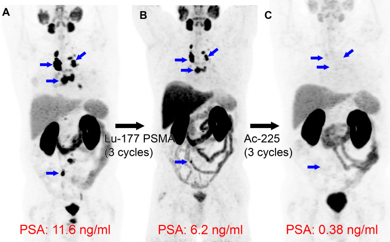 Actinium 225 (225Ac) prostate-specific membrane antigen (PSMA) α-particle therapy following lutetium 177 (177Lu) PSMA-617 β-particle therapy. Images in a 71-year-old man with widely metastatic prostate cancer, with a Gleason score of 7 (3 + 4), that progressed despite androgen deprivation therapy, taxane-based chemotherapy, and thoracic spine stereotactic radiation. (A) Baseline gallium 68 (68Ga) PSMA-11 PET/CT image demonstrates intense PSMA uptake in many nodal metastases (blue arrows). (B) Following three cycles of the targeted β-particle therapy with 177Lu-PSMA-617, the 68Ga-PSMA-11 PET/CT image demonstrates persistent PSMA-avid disease (blue arrows), with a mild reduction in prostate-specific antigen (PSA). (C) Following three cycles of the targeted α-particle therapy with 225Ac-PSMA-617, nearly complete resolution of uptake in the nodal metastases is observed (blue arrows in the location of previous nodal uptake), with a substantial reduction in PSA level.