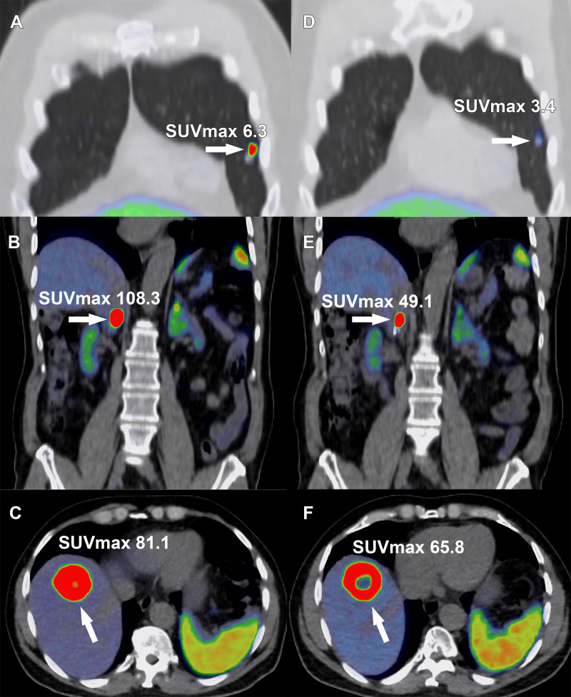 Images in a 68-year-old man with metastatic pheochromocytoma treated with four cycles of lutetium 177 (177Lu) tetraazacyclododecane tetraacetic acid octreotate (DOTATATE). A right adrenal pheochromocytoma was resected 2 years previously, with subsequent development of hepatic, osseous, and pulmonary metastasis and inferior vena cava (IVC) tumor thrombus. Selected gallium 68 (68Ga) DOTATATE PET/CT fusion images show a DOTATATE-avid (A) pulmonary metastasis (arrow), (B) IVC tumor thrombus (arrow), and (C) hepatic metastasis (arrow). Following completion of off-label 177Lu-DOTATATE therapy, (D) the pulmonary metastases (arrow), (E) IVC tumor thrombus, and (F) hepatic metastasis decreased in radiotracer uptake level. Central photopenia indicating tumor necrosis increased with the treated hepatic metastasis (E, arrow). SUVmax = maximum standardized uptake volume.