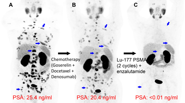 Complete treatment response after two cycles of lutetium 177 (177Lu) prostate-specific membrane antigen (PSMA)–617 therapy. Images in a 63-year-old man with widely metastatic prostate cancer, with a Gleason score of 9 (4 + 5). (A) Gallium 68 (68Ga) PSMA-617 PET/CT maximum intensity projection image demonstrates widespread metastatic disease, such as numerous bone lesions (blue arrows indicate select examples). (B) Following chemotherapy and hormonal therapy, persistent PSMA-avid metastatic lesions are observed on 68Ga-PSMA-11 PET/CT image, with slight reduction in prostate-specific antigen level. (C) Following two cycles of 177Lu-PSMA-617, there is complete resolution of metastatic PSMA uptake, with undetectable PSA. Blue arrows in the expected location of previous nodal uptake show the resolved lesions on 68Ga-PSMA-11 PET/CT image.