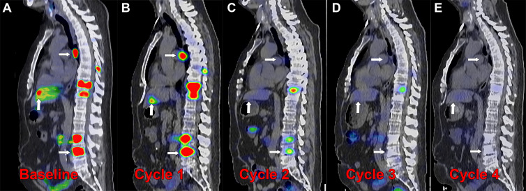 Posttherapy monitoring of index lesions with SPECT/CT imaging. Fused SPECT/CT sagittal images in a 56-year-old man with prostate-specific membrane antigen (PSMA)–avid metastatic prostate cancer undergoing lutetium 177 (177Lu) PSMA-617 therapy. (A) Baseline fluorine 18 (18F) carboxy-fluoro-pyridine-carbonyl-amino-pentyl-ureido-pentanedioic acid (DCFPyL) PET/CT image demonstrates intense PSMA uptake in nodal, osseous, and hepatic metastases (arrows). (B–E) Posttherapy SPECT/CT image with 177Lu-PSMA-617 was performed approximately 24 hours after infusion of the therapeutic radiotracer after each of four cycles administered 6 weeks apart, demonstrating localization of the therapeutic radiopharmaceutical to the metastases. Index lesions in lymph node, bone, and liver (arrows) demonstrate decreased intensity of uptake with each cycle of therapy. (C) After cycle 2, the hepatic and nodal metastases were no longer conspicuous, and (E) after cycle 4, the spine metastasis was no longer conspicuous. Imaging the therapeutic radionuclide enables confirmation of effective delivery to the sites of cancer and detection of treatment response over the course of therapy, demonstrated by the changes in the imaged index lesions over time.