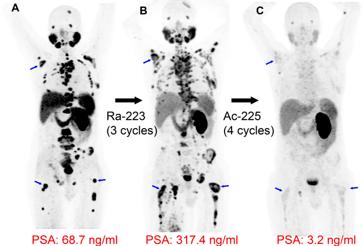 Targeted α-particle therapy: radium 223 dichloride (223RaCl2) followed by actinium 225 (225Ac) prostate-specific membrane antigent (PSMA)–617. Images in a 66-year-old man with widely metastatic prostate cancer, with a Gleason score of 8 (4 + 4), that progressed following androgen deprivation, chemotherapy, and pelvic radiation. (A) Baseline gallium 68 (68Ga) PSMA-11 PET/CT image demonstrates intense PSMA uptake in numerous metastatic lesions (blue arrows indicate examples in the right scapula and both femurs). (B) 68Ga-PSMA-11 PET/CT image following three cycles of 223RaCl2 (a targeted α-particle therapy that incorporates within osteoblastic lesions but does not directly bind to cancer cells) shows progression of many osseous metastases (blue arrows), and the prostate-specific antigen (PSA) value increased. (C) Lutetium 177 (177Lu) PSMA-617 and 225Ac-PSMA-617 were both considered as treatment options. Following multidisciplinary discussion and shared decision-making with the patient, four cycles of 225Ac-PSMA-617 (a targeted α-particle therapy with affinity for PSMA) were administered 6 weeks apart, demonstrating dramatic response in the metastatic lesions, with near resolution of PSMA uptake at 68Ga-PSMA-11 PET/CT (blue arrows in the location of previous lesions) and a corresponding dramatic reduction in PSA.