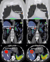 Images in a 68-year-old man with metastatic pheochromocytoma treated
with four cycles of lutetium 177 (177Lu) tetraazacyclododecane tetraacetic
acid octreotate (DOTATATE). A right adrenal pheochromocytoma was resected 2
years previously, with subsequent development of hepatic, osseous, and
pulmonary metastasis and inferior vena cava (IVC) tumor thrombus. Selected
gallium 68 (68Ga) DOTATATE PET/CT fusion images show a DOTATATE-avid (A)
pulmonary metastasis (arrow), (B) IVC tumor thrombus (arrow), and (C)
hepatic metastasis (arrow). Following completion of off-label 177Lu-DOTATATE
therapy, (D) the pulmonary metastases (arrow), (E) IVC tumor thrombus, and
(F) hepatic metastasis decreased in radiotracer uptake level. Central
photopenia indicating tumor necrosis increased with the treated hepatic
metastasis (E, arrow). SUVmax = maximum standardized uptake
volume.
