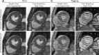 Artificial intelligence (AI)–based resolution enhancement.
Collecting balanced steady-state free precession cardiac MRI scans with
lower resolution reduces scan time since fewer data are acquired.
Acceleration reduces the breath-hold time needed in breath-hold
electrocardiogram (ECG)–gated sequences or enables free-breathing
real-time imaging with high temporal resolution. (A) Cine images in the
short-axis plane show enhancement of spatial resolution using a generative
adversarial network. (B) Tagging images in the short-axis plane show
enhancement of spatial resolution using a pretrained model based on cine
images.