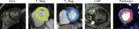 Automated segmentation using convolutional U-Net convolutional neural
networks. Automated segmentation based on U-Net architectures has been
demonstrated across many cardiac MRI sequences, including cine, T1 and T2
mapping, late gadolinium enhancement (LGE), and perfusion images.