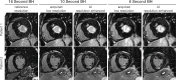 Artificial intelligence (AI)–based resolution enhancement. A
pretrained AI-based resolution enhancement model based on balanced
steady-state free precession cardiac MRI cine data can be used to accelerate
inversion recovery late gadolinium enhancement imaging, as shown in images
in the short-axis plane. For instance, current existing sequences require a
16-second breath hold (BH) for imaging, with one breath hold for each
section. The imaging time can be reduced to 10 seconds or even 6 seconds at
the expense of diminished spatial resolution. The AI model is used to
enhance the spatial resolution in images with shorter imaging
time.